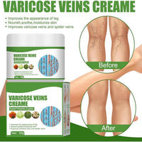 Varicose Vein Cream ( BUY 1 GET 1 FREE )